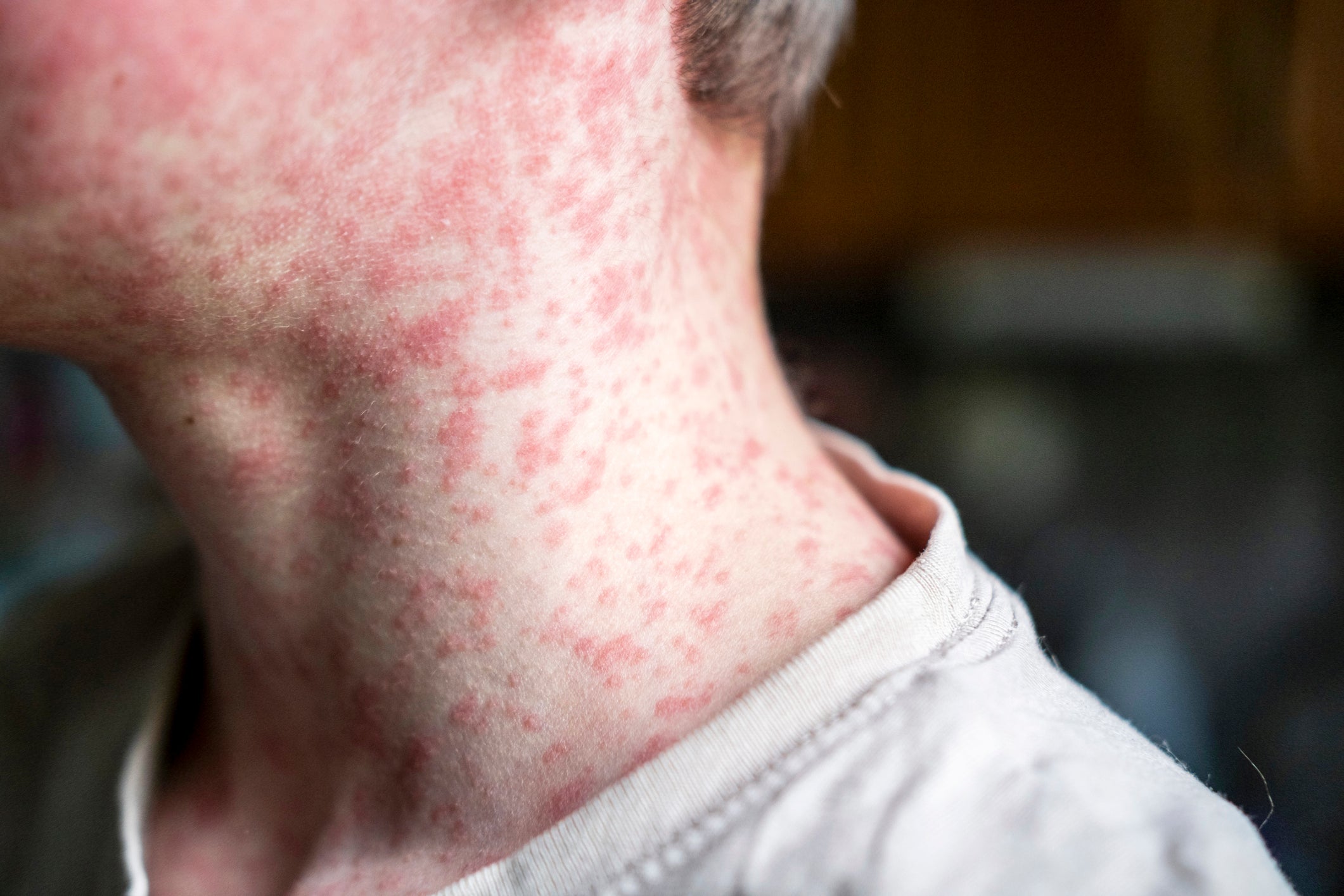 A historic outbreak of measles in West Texas has spread. State health officials said cases had ballooned to nearly 60 by Tuesday