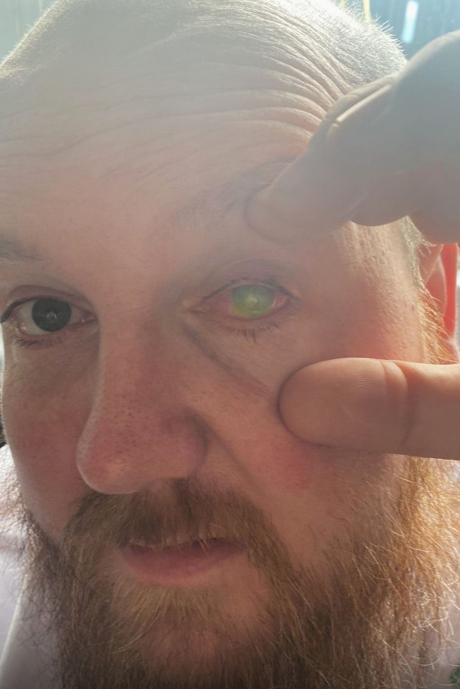 Paul Laskey’s eye was badly damaged in an acid attack in February 2023