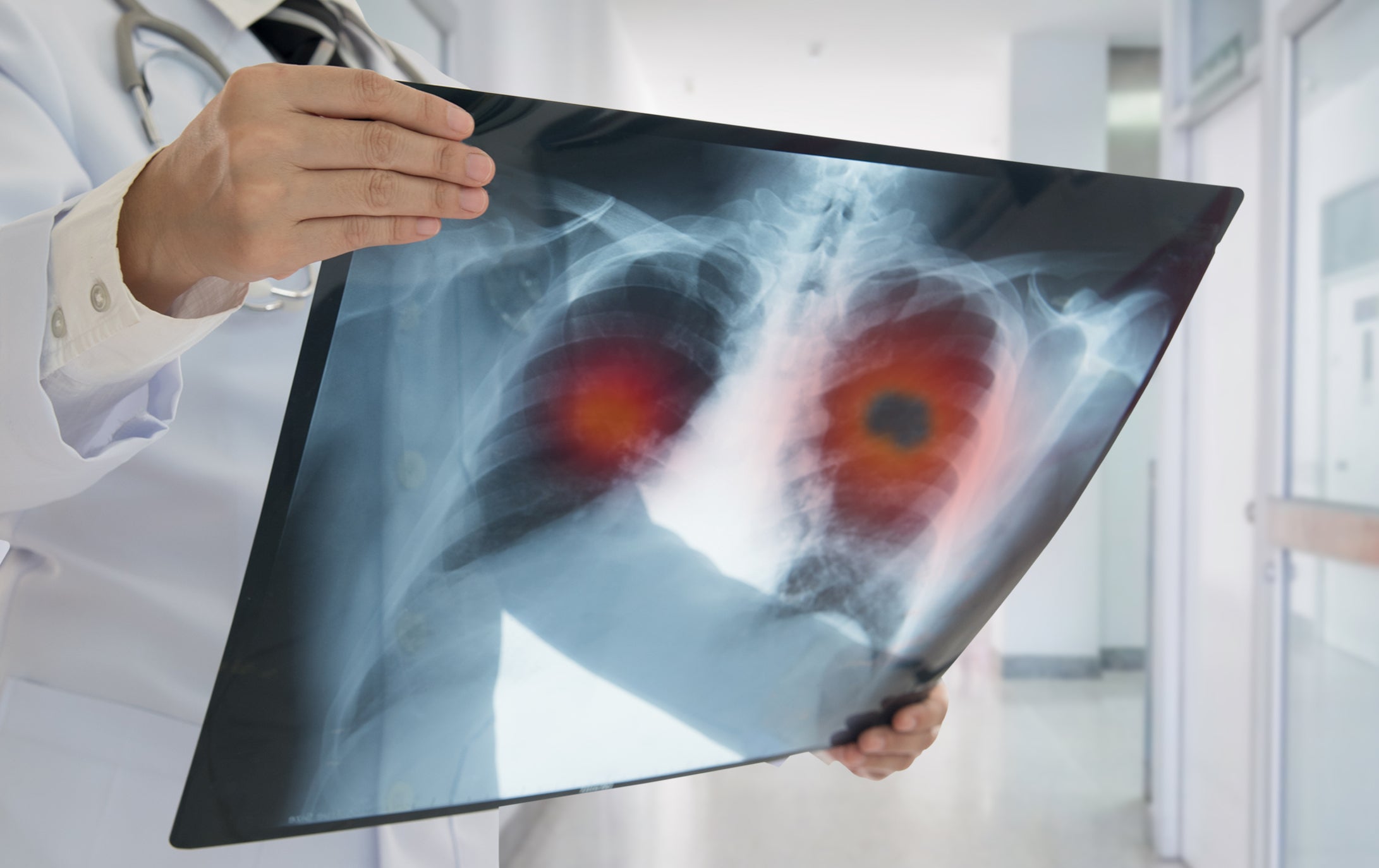 Lung cancer almost half of the extra deaths in cancer among the most poorest people