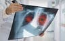 Scientists say these health issues might be a sign of lung cancer