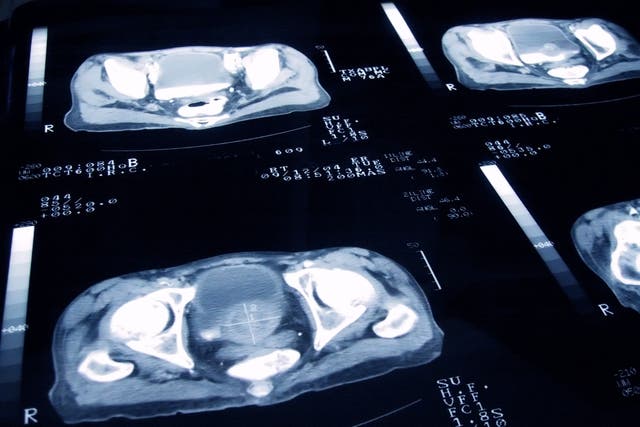 <p>Según un nuevo estudio, habría una nueva prueba casera de saliva para detectar cáncer de próstata que podría ser más efectiva que los métodos actuales</p>