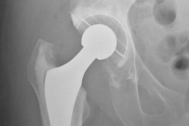 The medical equipment firm makes knee and hip replacements (Stuart Johnson/University of Bristol/PA)