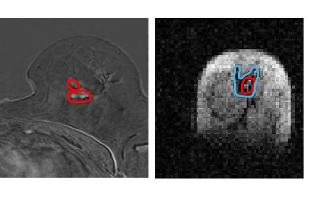 Side by side image of same breast tissue in MRI and FCI. (l) MRI image of breast with cancerous tumours circled in red (r) FCI image of same breast shows same tumour in red with secondary tumour spread in blue (University of Aberdeen/PA)