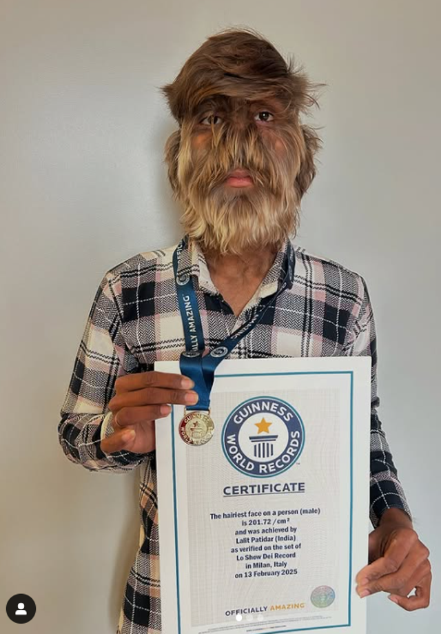 <p>Lalit Patidar from Madhya Pradesh in India has a rare condition called 'werewolf syndrome' </p>