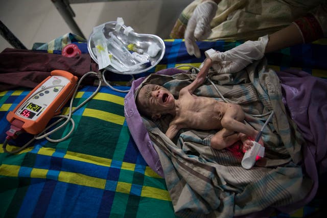 <p>A severely malnourished, premature 15 day old baby gets treated in the pediatric - neonatal unit at the 'Doctors Without Borders' Kutupalong clinic in 2017</p>