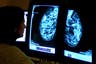 The only way to spot the earliest warning sign of cancer