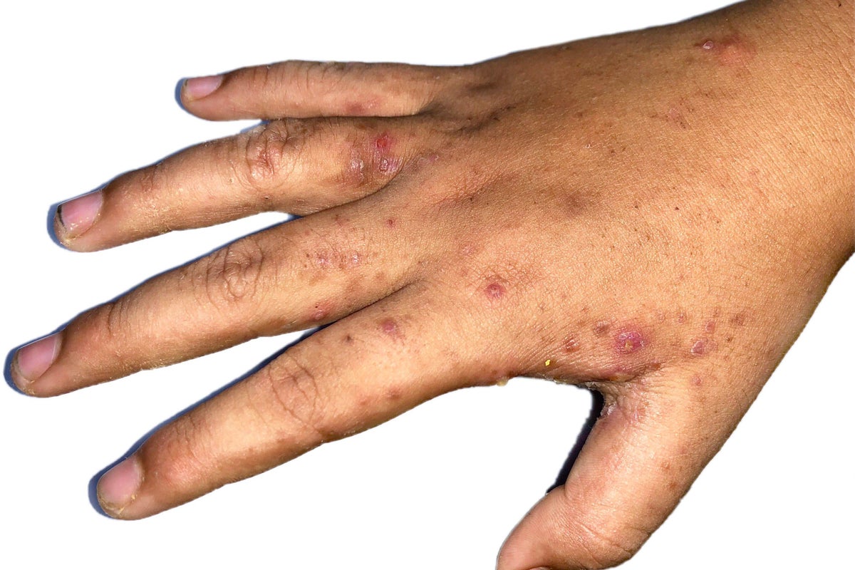Scabies is surging across the UK and Europe. Here are the symptoms