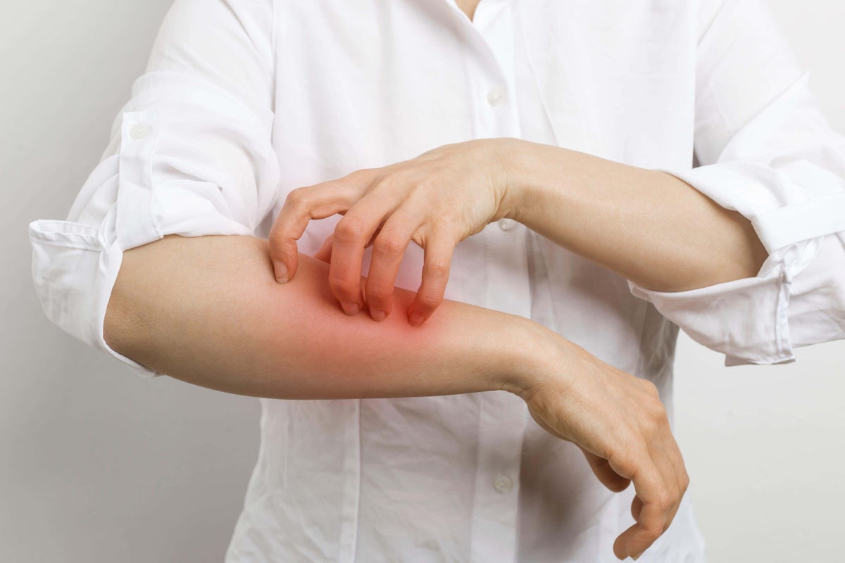 How to spot, treat and prevent scabies