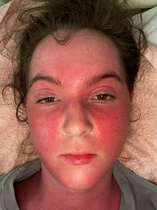Young woman would ‘do anything’ to have eczema again after extreme reaction