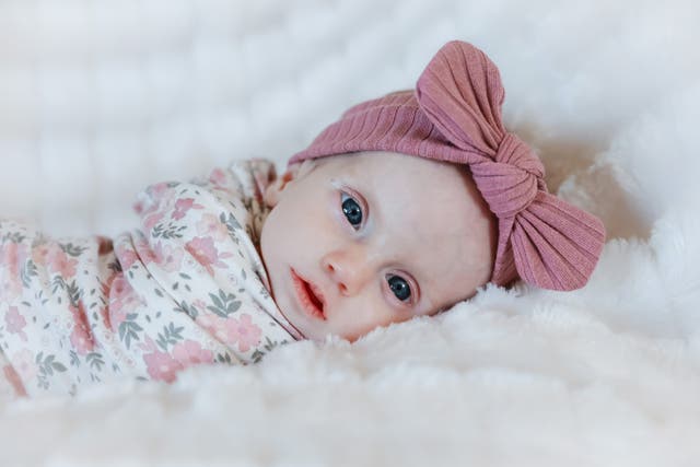 <p>Hazel was born with facial paralysis</p>
