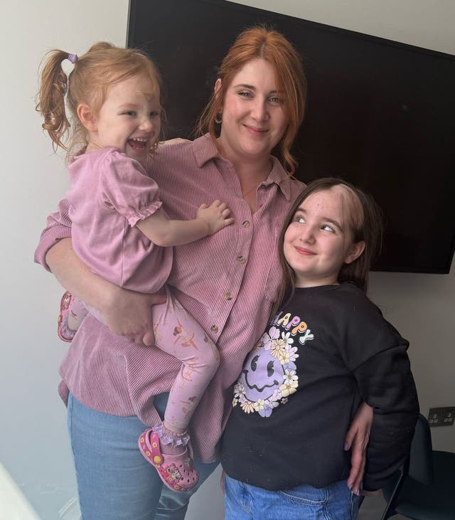 <p>Esmai is now losing her hair in the area targeted by her radiotherapy treatment</p>