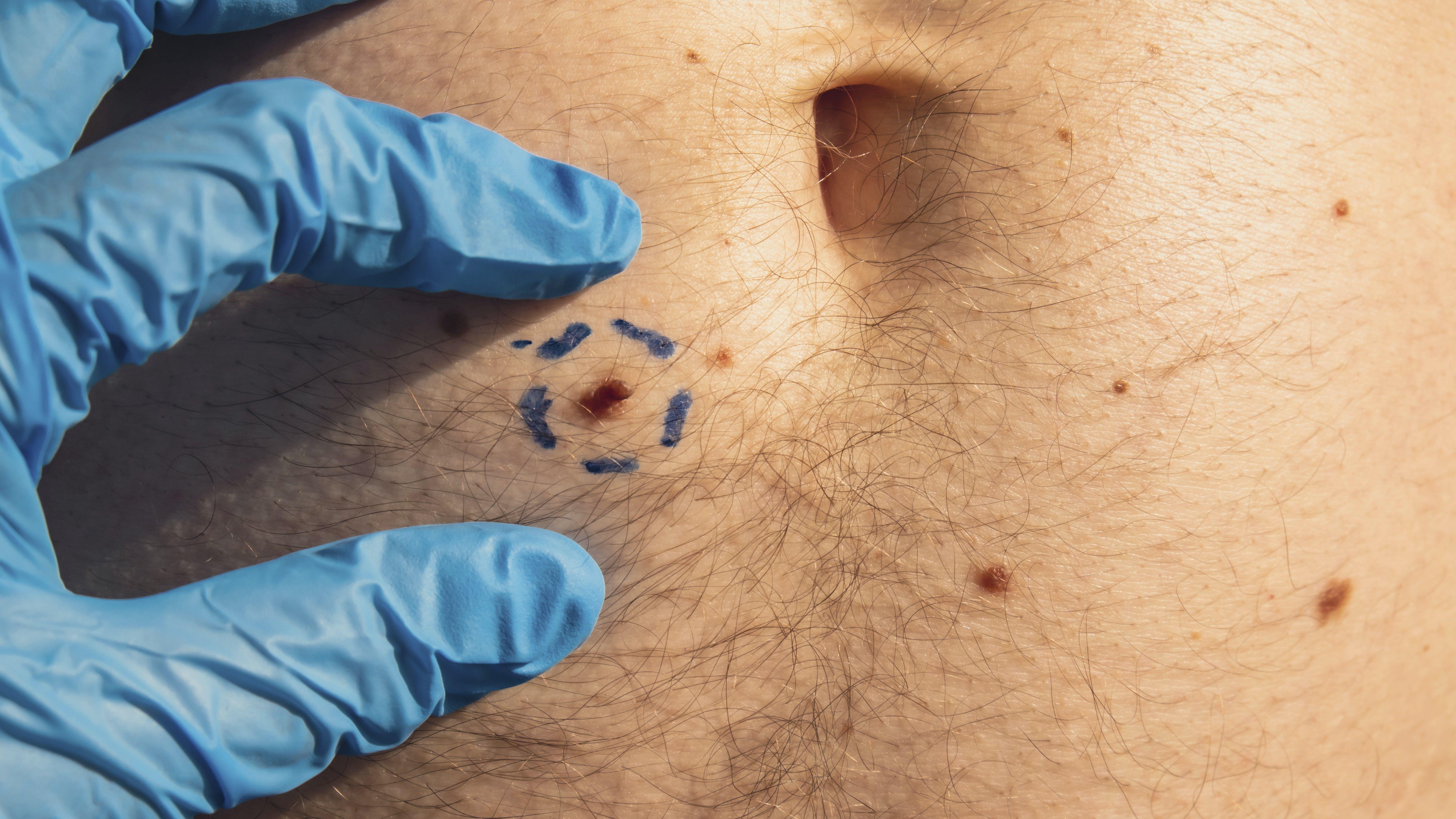 Even benign lesions are subject to change