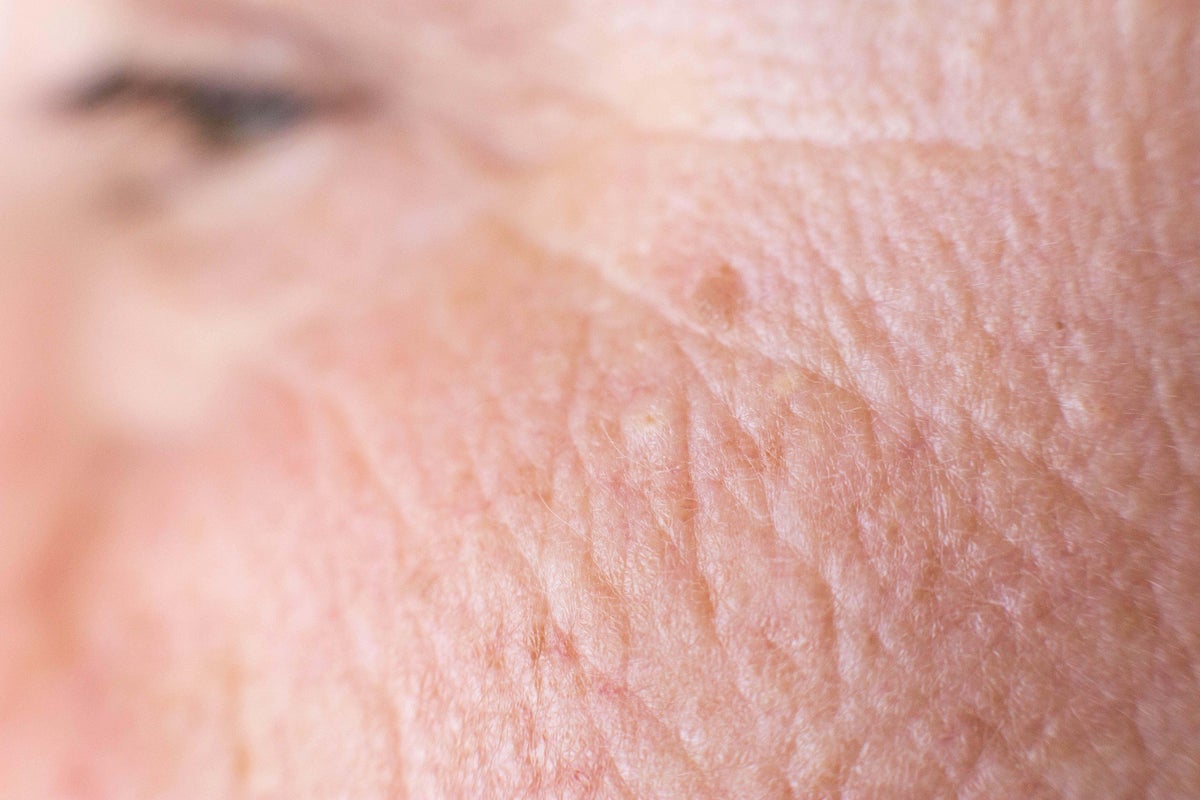 Melanoma awareness month: Is it an age spot or skin cancer?
