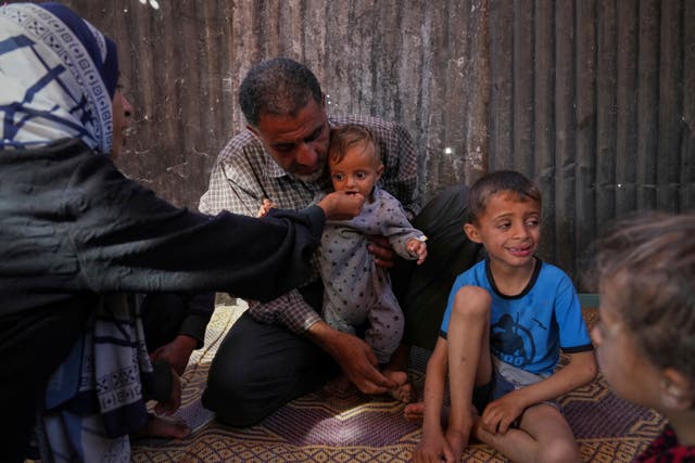 Mideast Wars Malnourished Children