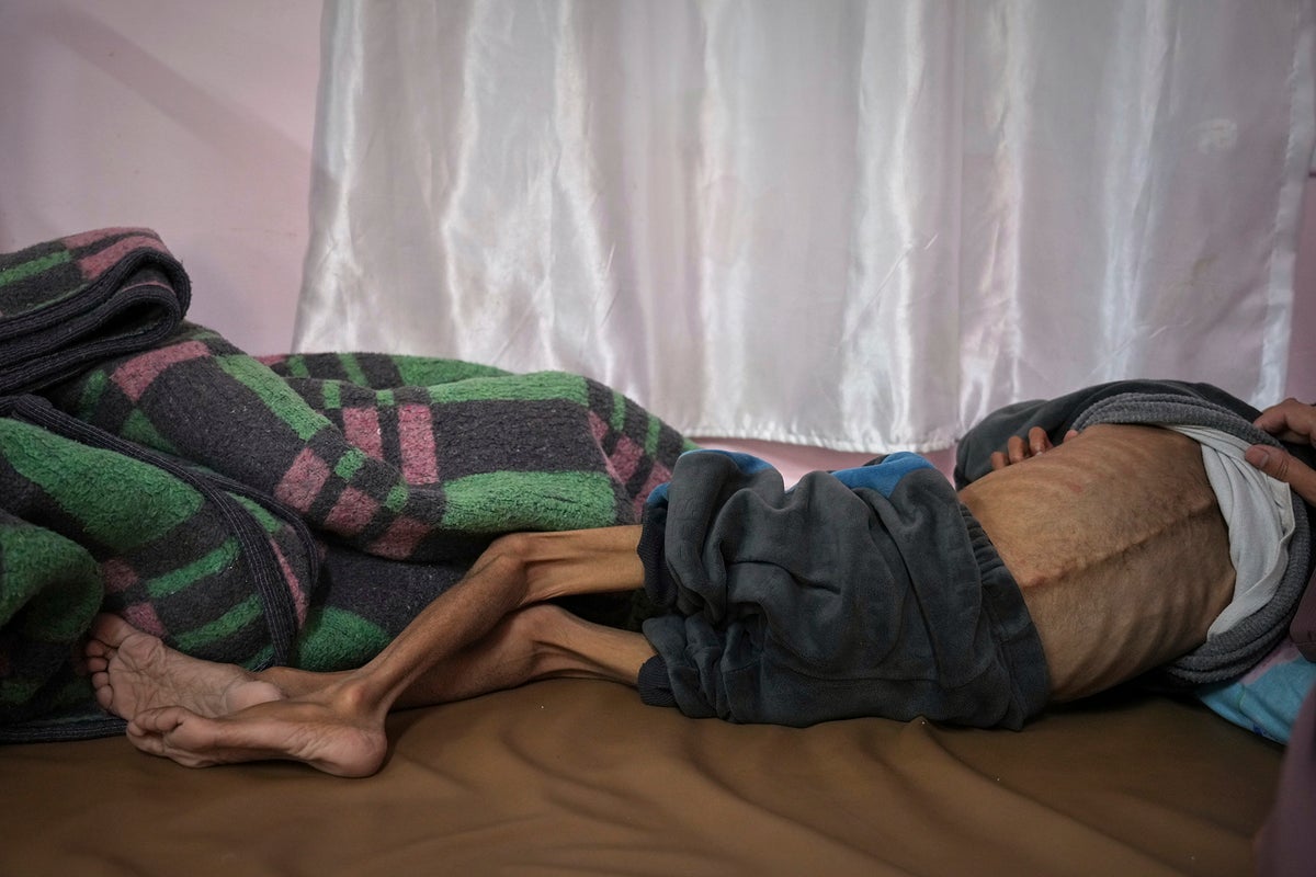 Children so malnourished they’re losing their sight: Inside Israel’s aid blockade on Gaza