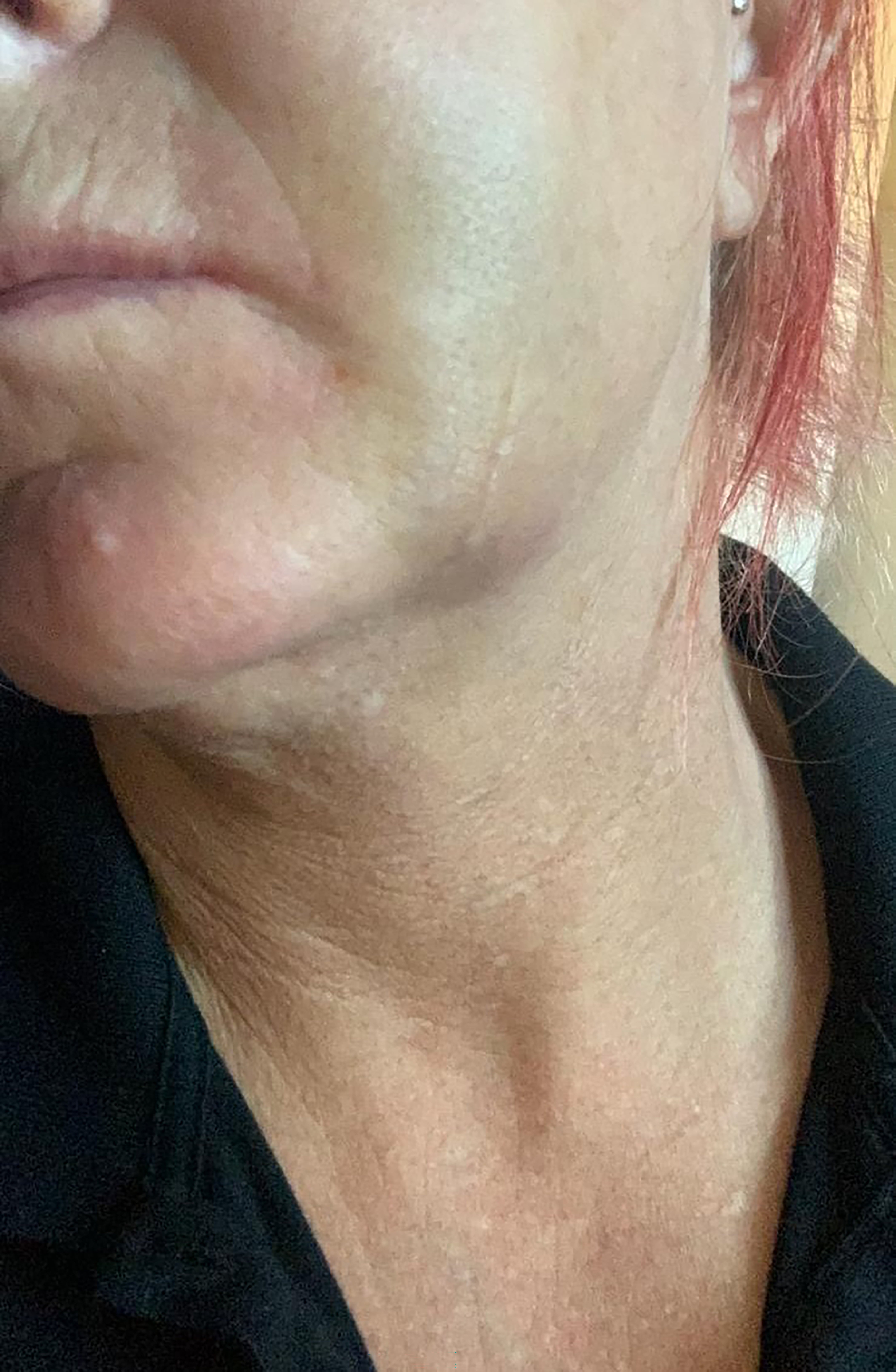Emily said the dentist, who also cannot be named, abandoned the extraction and said her jaw had been fractured, and this led to several complications afterwards, including infections, sinus issues and pus dripping into her throat