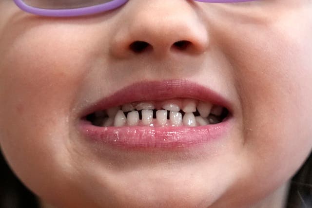 Fluoride Supplements-FDA