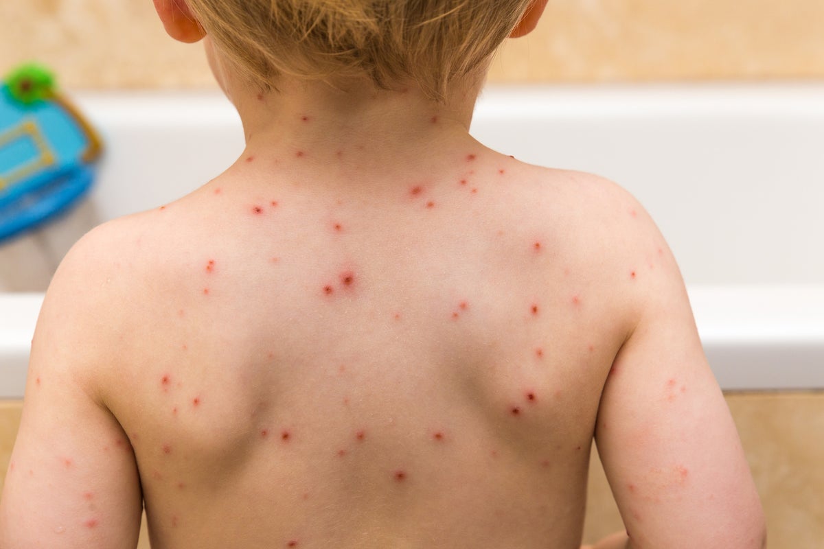 Why is the NHS offering the chickenpox vaccine and is my child eligible?