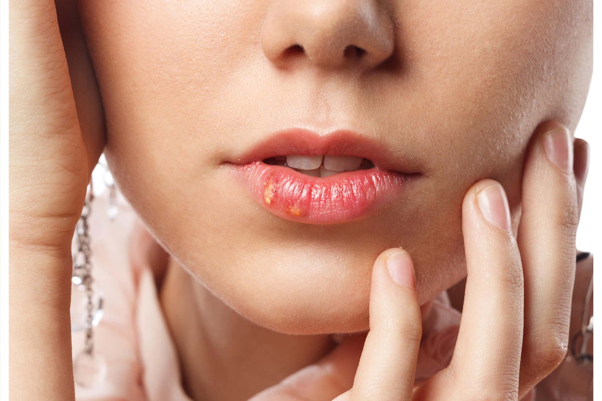 Treating cold sores with anti-virals ‘may slash risk of developing Alzheimer’s’
