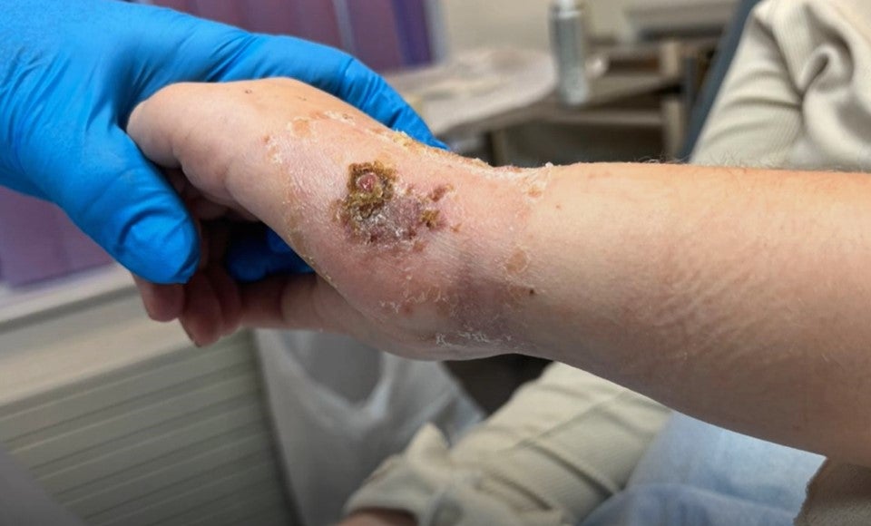 Chloe Norris, was left with scars after nail glue damaged her nerves