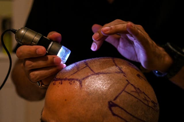 <p>Representative: A doctor inspects the scalp of a patient before a hair transplant proceedure</p>