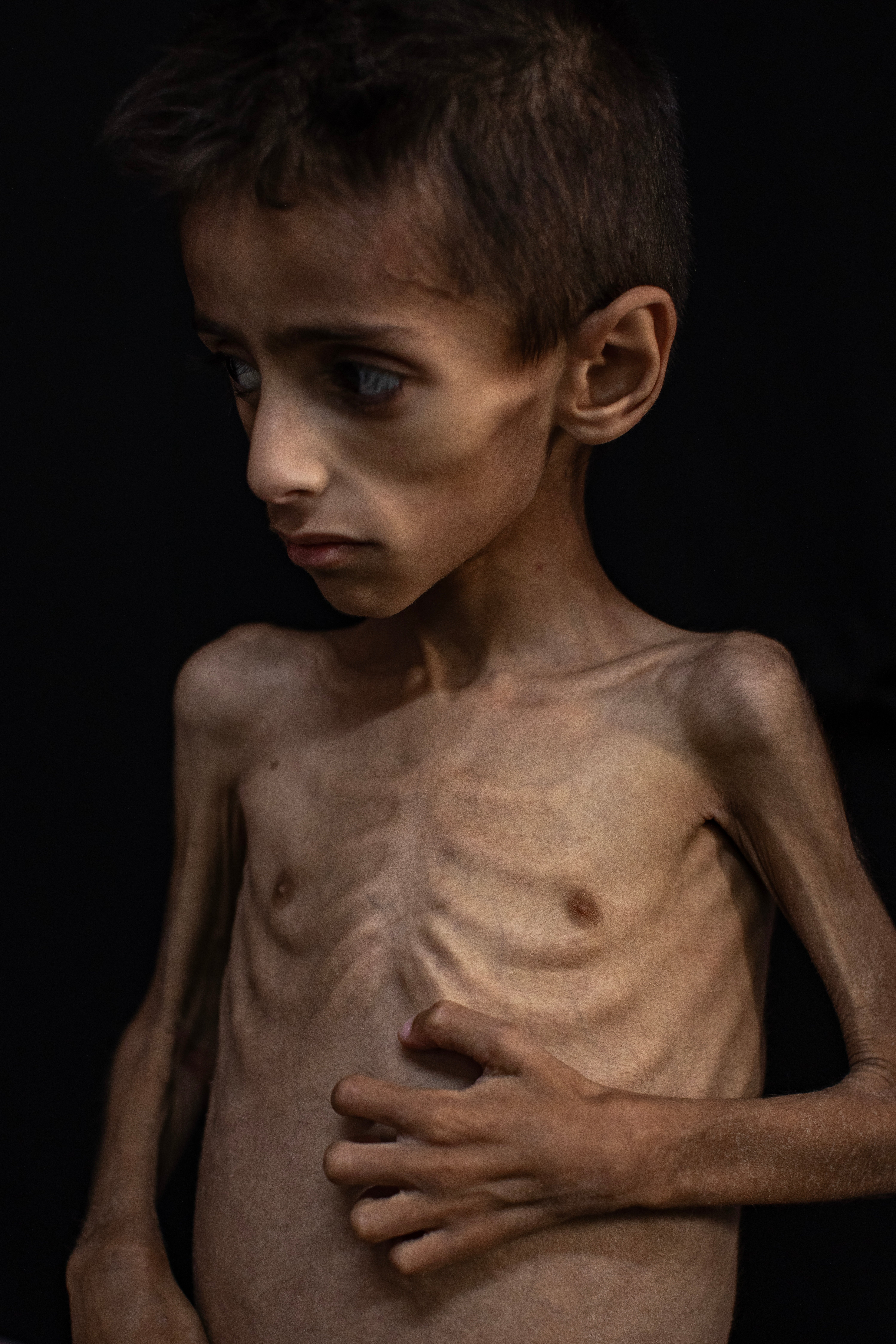 Five-year-old Osama Al-Raqab, suffering from severe malnutrition, is subjected to treatment at Nasser Hospital in Kan Youni in South Gaza