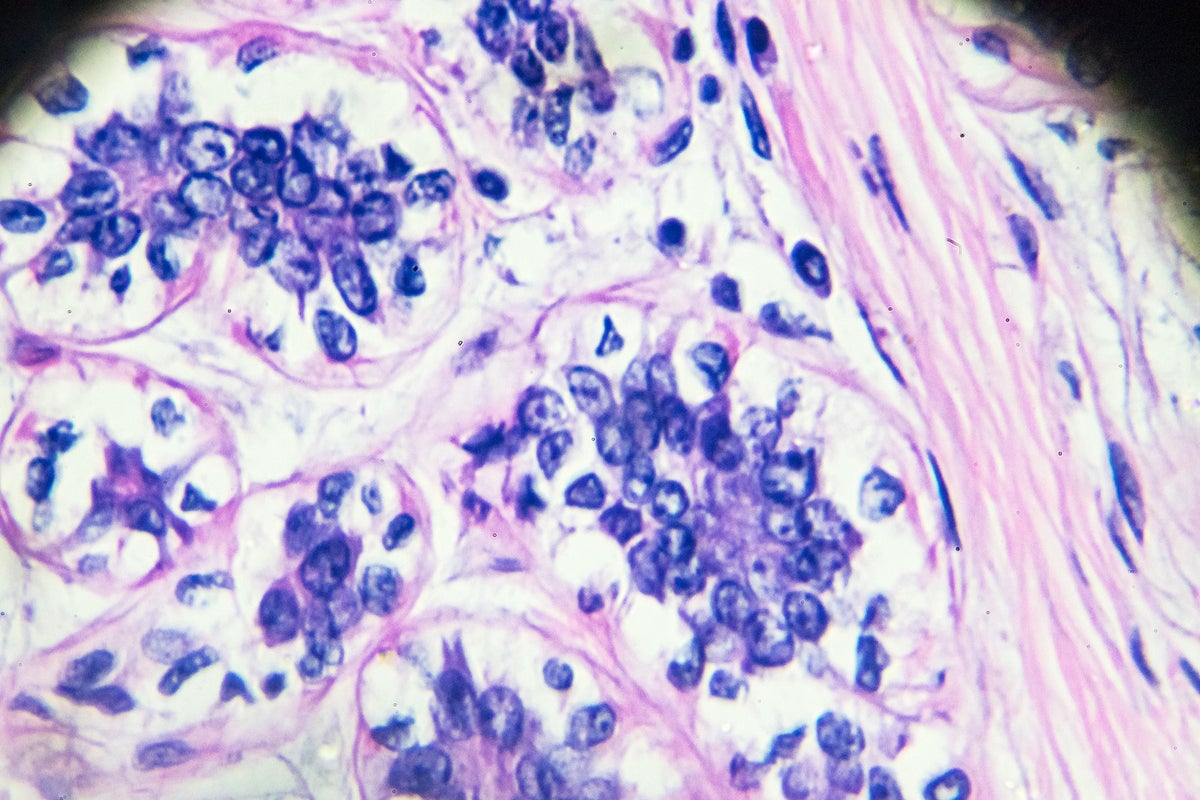 ‘Transformational’ new breast cancer drug could halt the growth of tumours