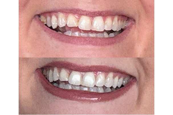gleam teeth whitening review tried and tested indybest 