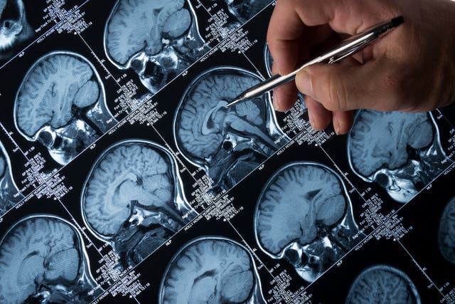 <p>A simple blood test could predict Alzheimer’s decline</p>