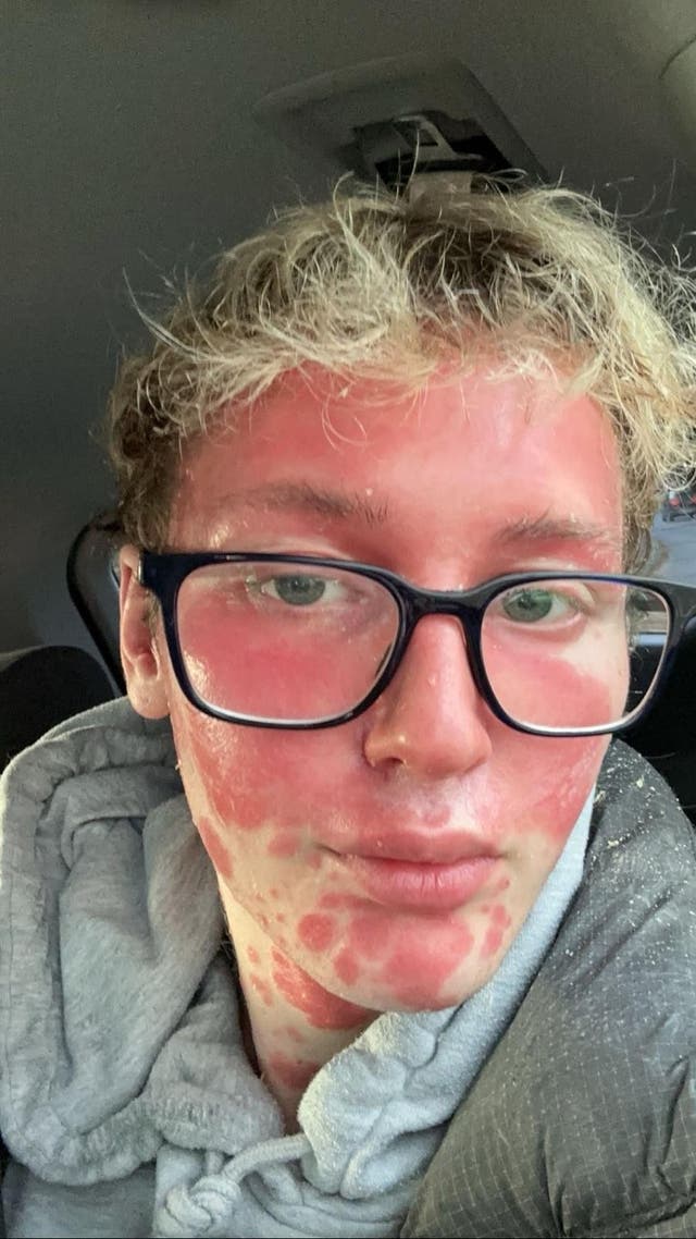 <p>Social media and TV personality Charlie Michael Baker was diagnosed with psoriasis in July 2024</p>