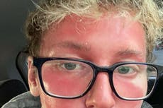 Fillers triggered painful skin condition that left teenager looking ‘like an alien’