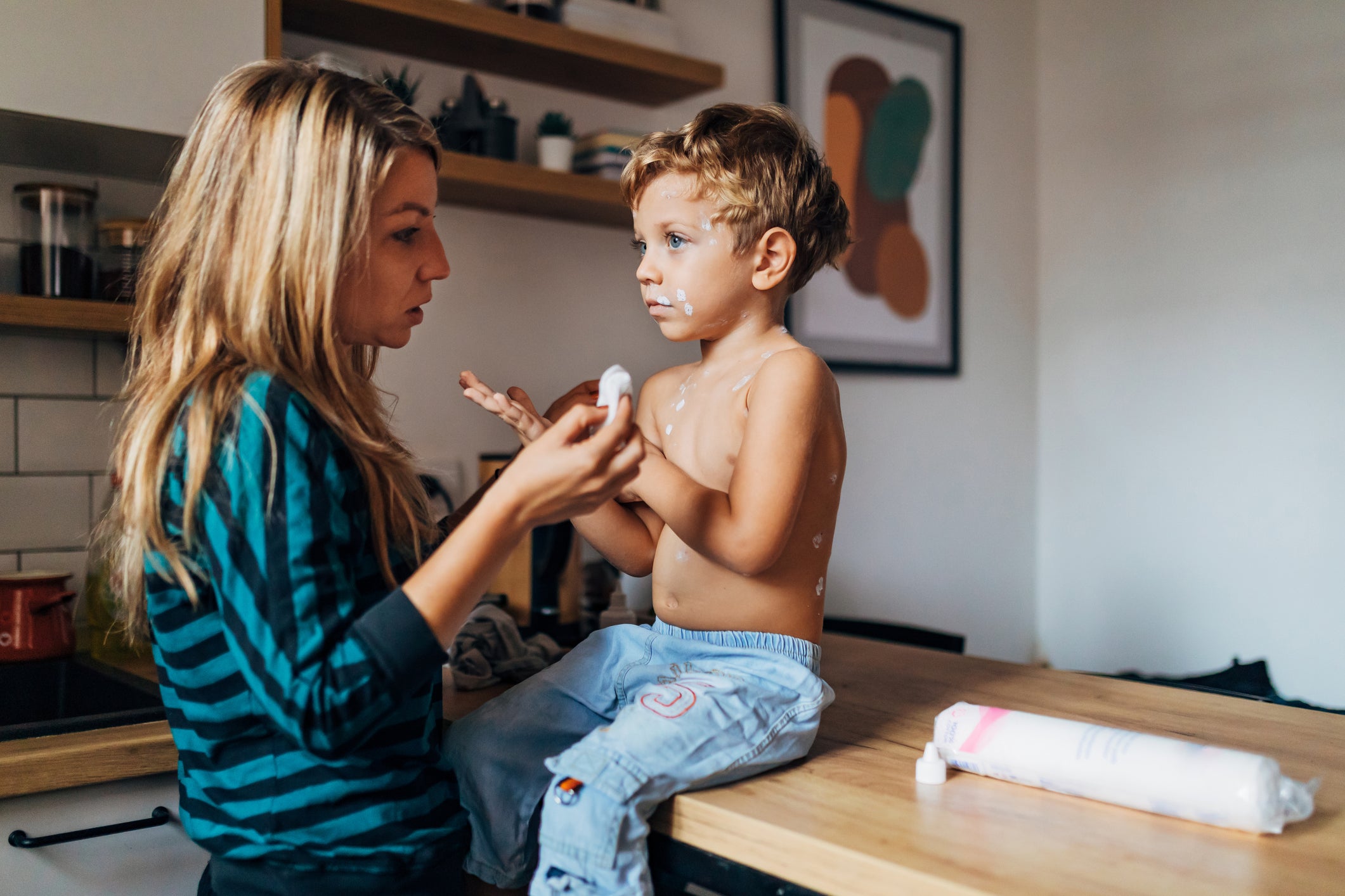 Measles Cases Rise in the UK Urgent Call for MMR Vaccinations Before Summer Travel