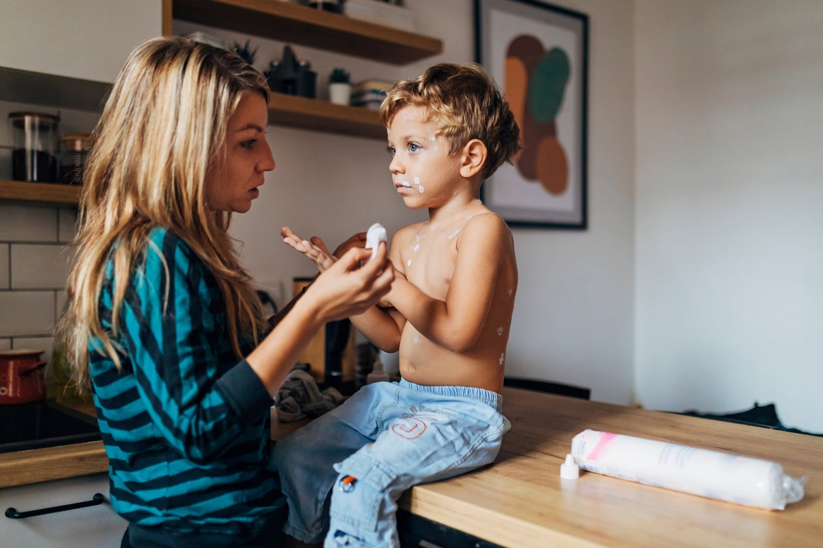 What are the symptoms of measles and how can I get my child vaccinated as cases rise?
