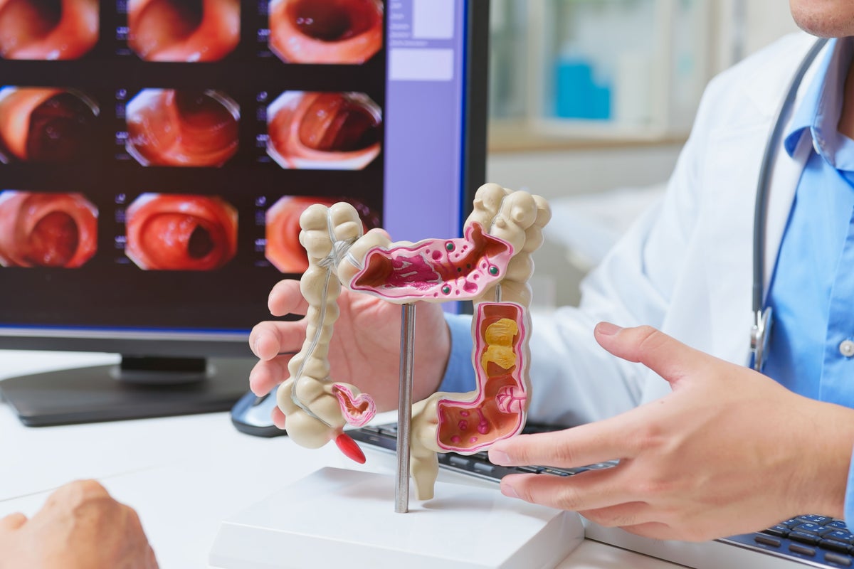 Scientists celebrate bowel cancer breakthrough in bid to tackle surge in young people
