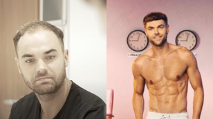 Love Island star unrecognisable in pre-hair transplant video 