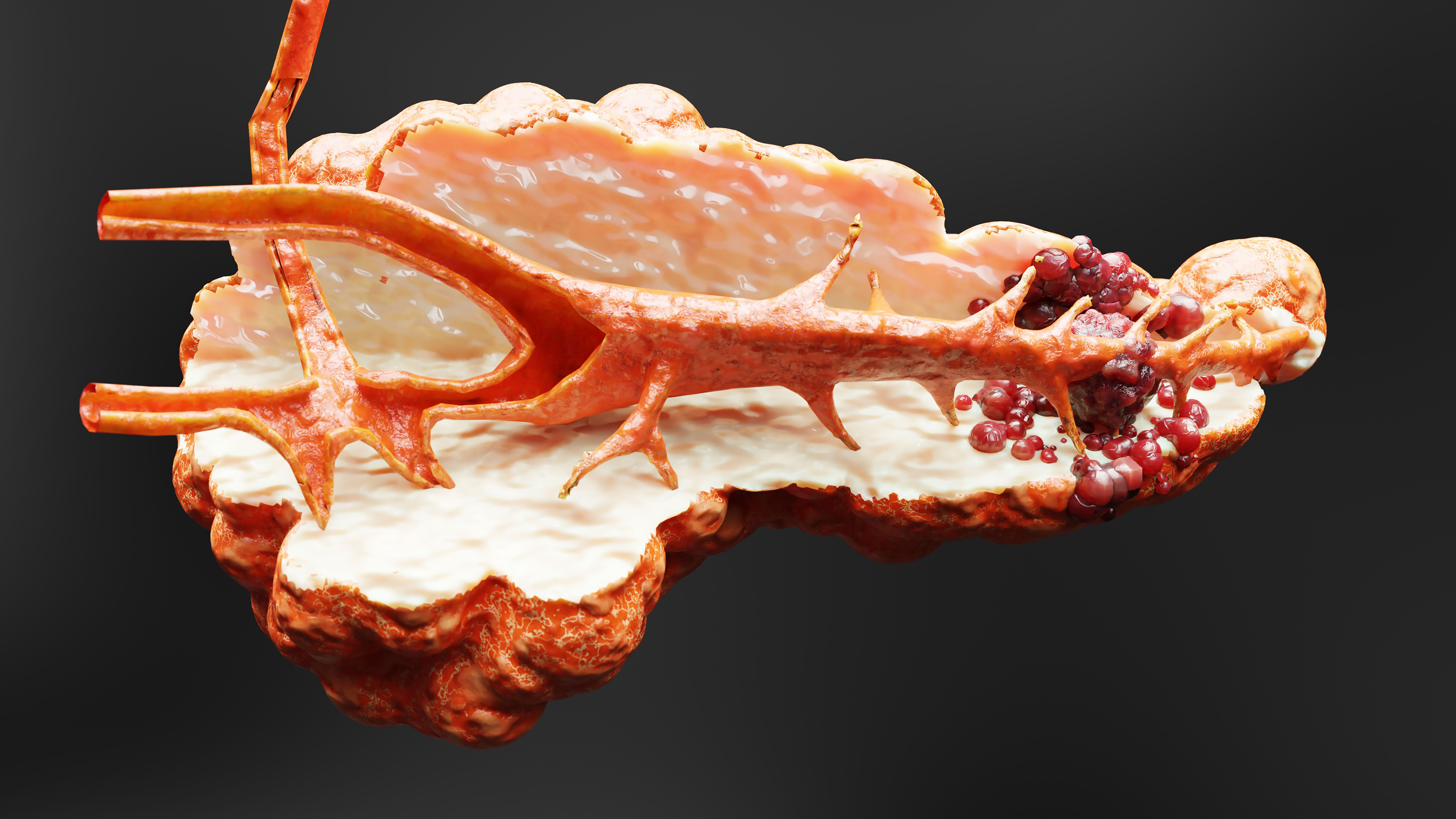 Pancreatic cancer can have vague symptoms and is often diagnosed in the late stages.