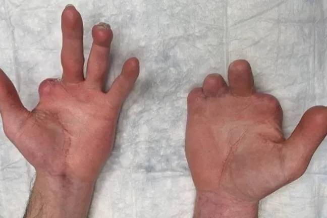 The pipefitter had to undergo 25 surgeries, which left most of his fingers amputated