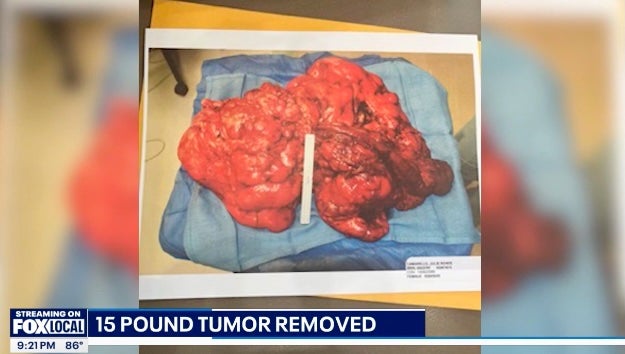 The large tumor was removed with clear margins during a May surgery in Chicago