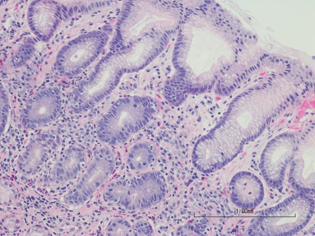 Helicobacter pylori infections were responsible for the greatest number of cancer cases in 2024