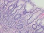 Almost 12 million stomach cancer cases linked to common infection