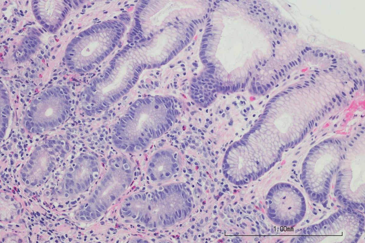 Almost 12 million stomach cancer cases linked to common infection