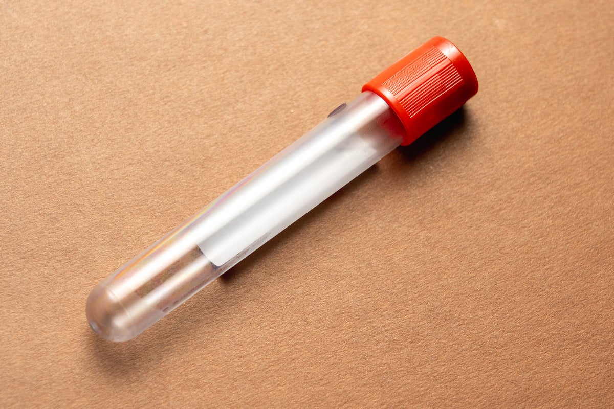 Simple blood test could accurately detect ovarian cancer in its early stages