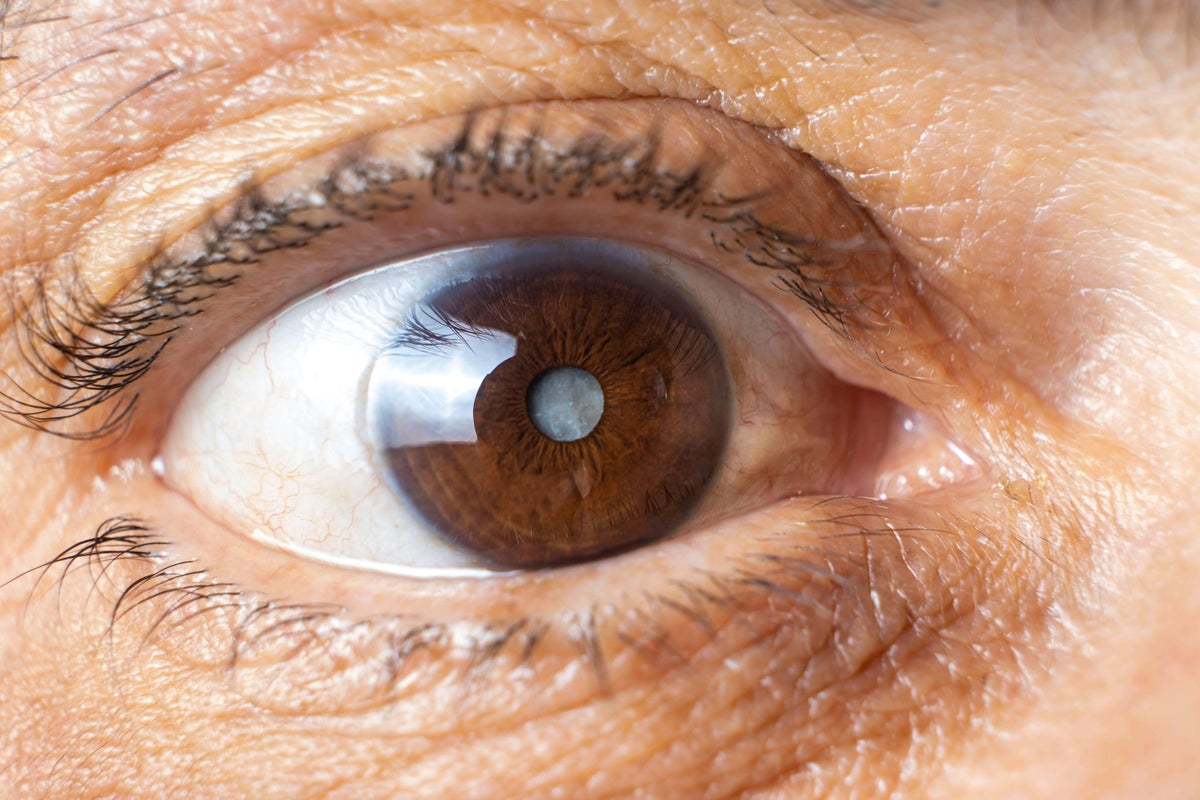 How to spot the early signs of a cataract