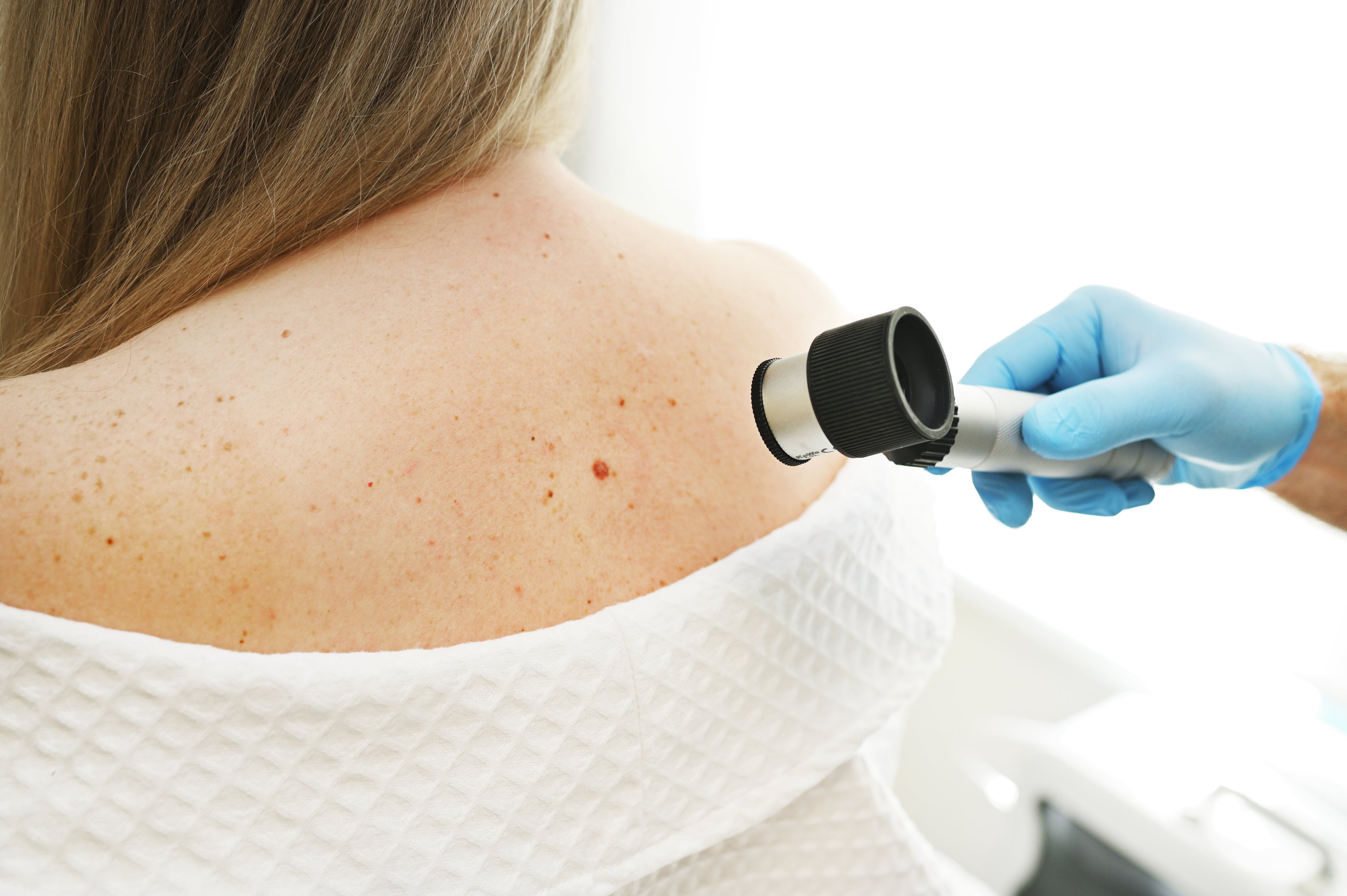 A dermatologist examines moles and skin growths on a patient's body using a special device