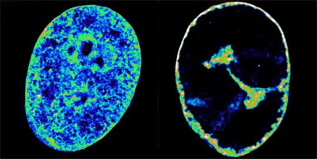 <p>Human cells before and after herpes virus infection</p>