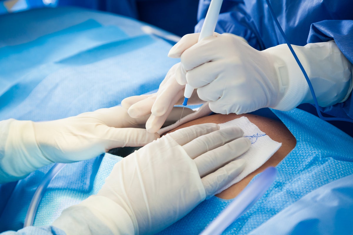 Planned C-sections can increase the risk of certain childhood cancers, researchers say