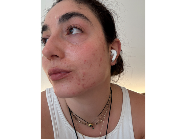 Best pimple patches IndyBest review The Inkey List hydrocolloid invisible pimple patches