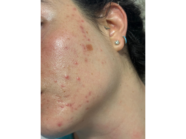 best pimple patches IndyBest review Zitsticka hyperfade dark spot microdart patch