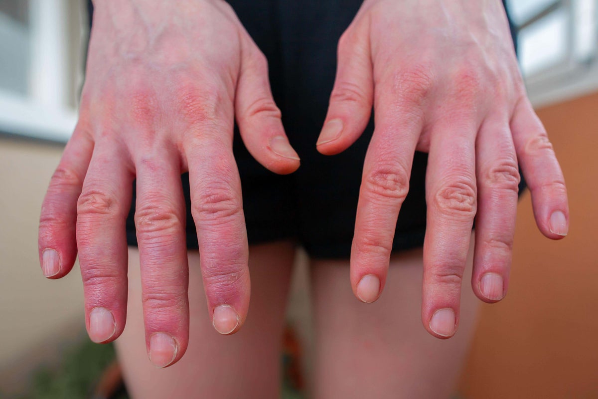 Why do my hands and feet swell in the summer?