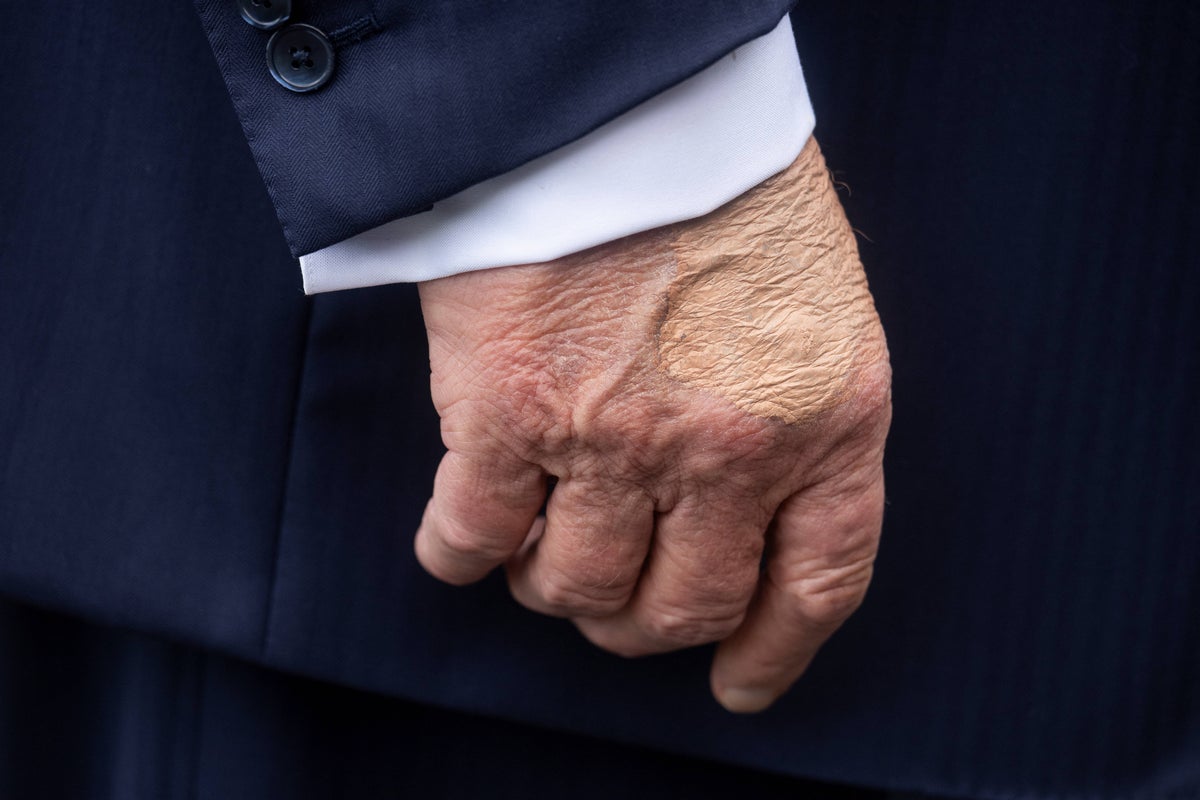 Trump’s strange bruised hand makes reappearance before president’s visit to Pittsburgh